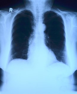 Nuevo Enfoque Para El Tratamiento De Las Infecciones Pulmonares De La Fibrosis Quística